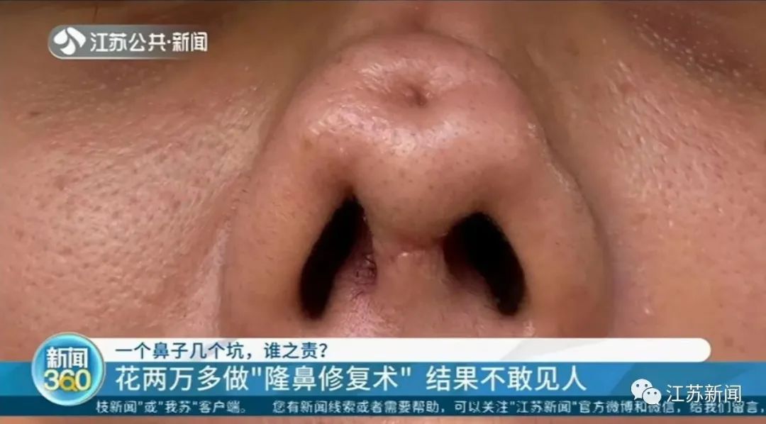 女子整形完鼻子变4个洞 医院：抽烟导致鼻子感染